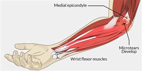 Tendons to attach the muscles to the bones. Suffering from Golfer's Elbow, are you? Then ...
