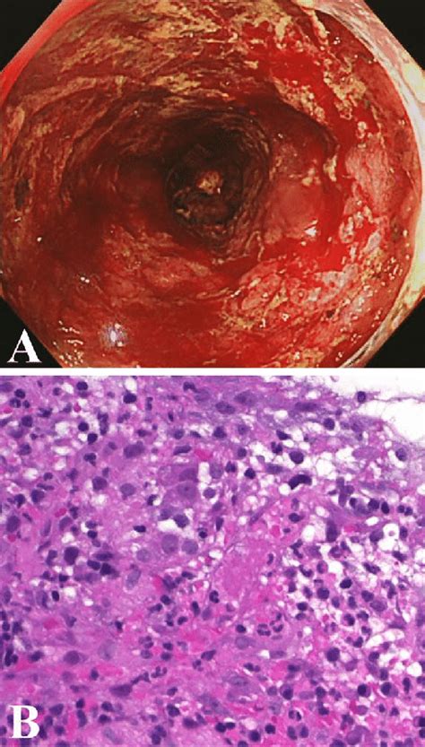 Figure1the Endoscopic And Pathological Findings Of The Colon Lesion On
