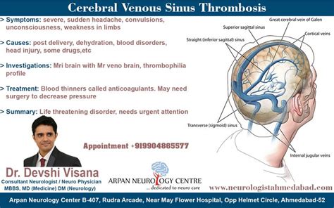 Cerebral venous thrombosis (cvt) is a type of stroke caused by thrombosis of the dural sinus and/or cerebral veins. Cerebral venous sinus thrombosis (CVST) is the presence of ...