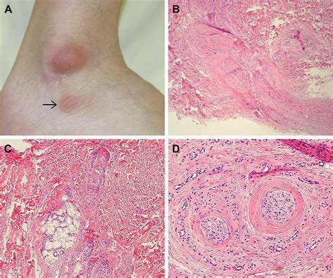 A Two Erythematous Subcutaneous Masses Were Found Near The Right