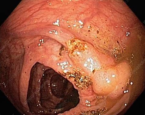 Colons and semicolons have different functions. Colon cancer, endoscopic view - Stock Image - C016/8307 ...