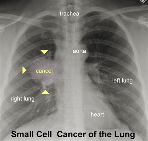 chest xray cancer