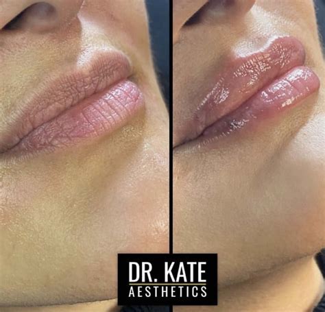 before and afters lip fillers aesthetics and skin care clinic in north london dr kate aesthetics