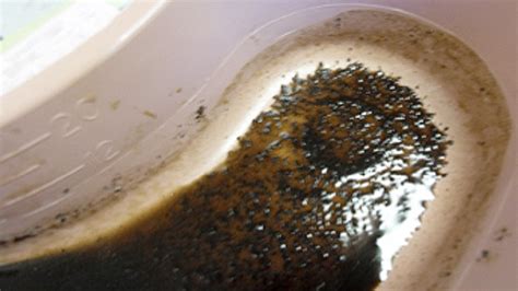 Coffee Ground Vomitus Causes Diagnosis And Treatment