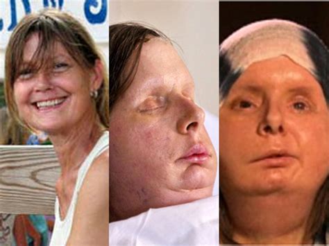 military hopes to learn from chimp attack victim s face transplant cbs news