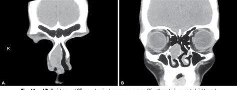 Figure 1 From Pleomorphic Adenoma Of Nasal Cavity A Rare Case Report