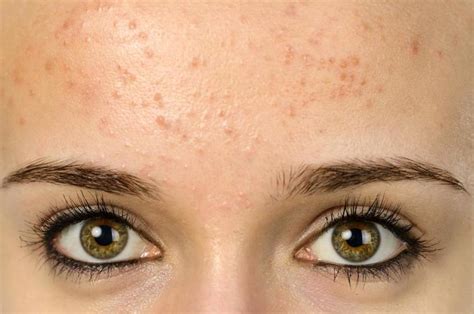 How Can I Get Rid Of Pimples On The Forehead Acne Help Mdacne