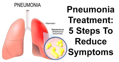 Best Antibiotics For Aspiration Pneumonia