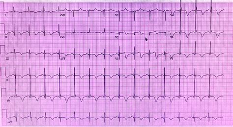 Cerebral T Waves And The Underlying Concern They Infer Shm Abstracts