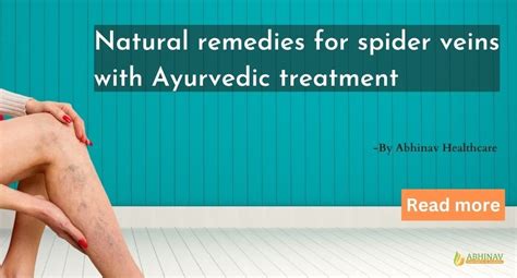 Natural Remedies For Spider Veins With Ayurvedic Treatment