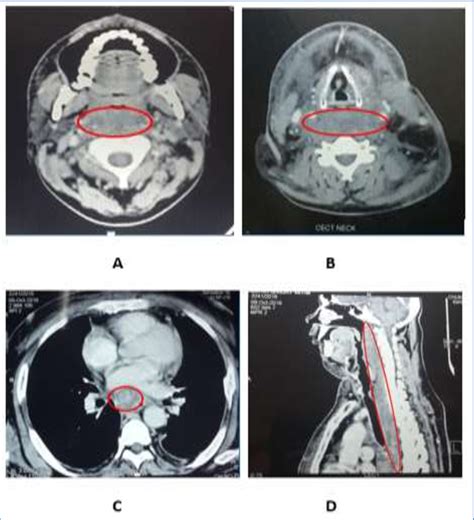 A And B Showing The Extent Of Neck Swelling At Initial Presentation To