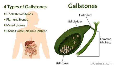 What Are Gallstonestypescausessymptomstreatmentrisk Factors