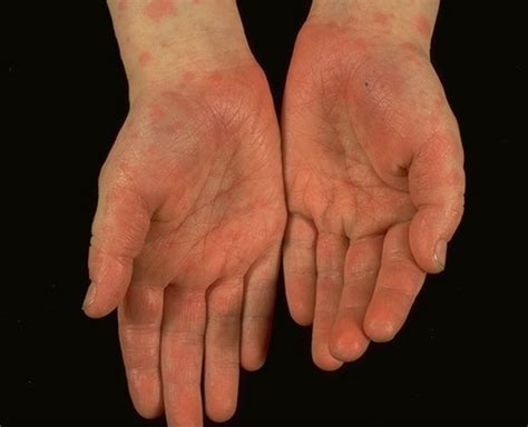 What Causes Red Spots On The Palms Of Hands