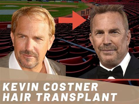 Kevin Costner Hair Transplant Hair Loss And Technical Analysis