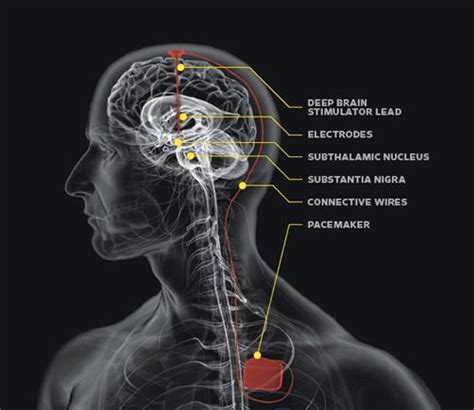 Deep Brain Stimulation For Parkinsons Disease Neurosurgery