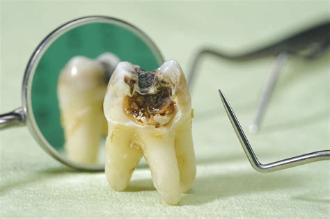 What Do Dental Cavities Look Like And When To See A Dentist