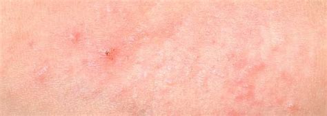 Identify Different Types Of Skin Rashes And Causes Skin Cares