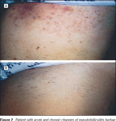 Pdf Treatment Of Pseudofolliculitis With A Pulsed Infrared Laser