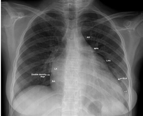 Rheumatic Giant Left Atrium—an Overview