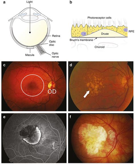 Changes In Ocular Phenotype With Age Related Macular Degeneration Amd