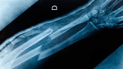 Are All Types Of Fractures Predictive Of Osteoporosis Medpage Today