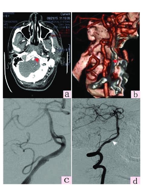 Right Vertebral Artery V4 Segment Dissection Aneurysm Treated With Lvis