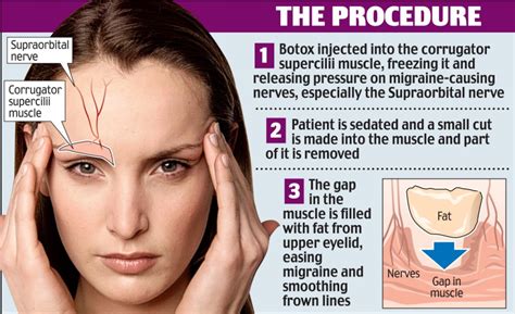 Could A Facelift Put An End To Your Migraines One Hour Surgery Offers
