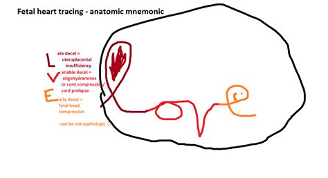 Anatomic Mnemonic For Fetal Heart Tracings Scrolller