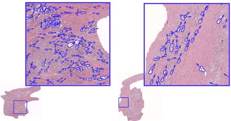 They use these risk levels to help them develop treatment plans. Changes in benign tissue next to prostate tumors may ...