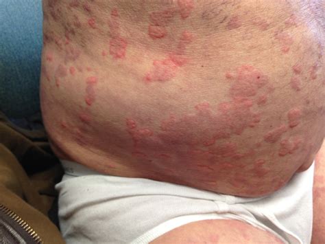 Widespread Erythematous Rash Page 3 Of 4 Clinical Advisor