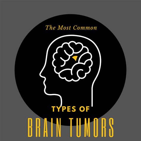 The Most Common Types Of Brain Tumors Premier Neurology And Wellness Center