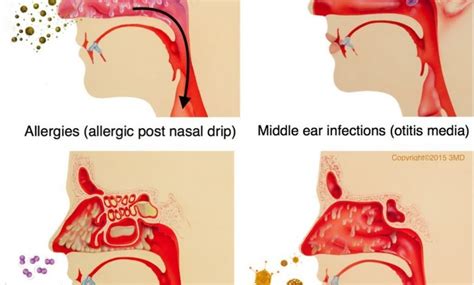 Nasal Drip Drip Know Your Meme Vrogue Co