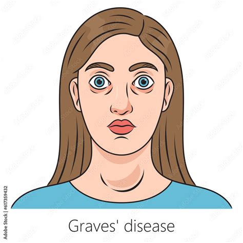 Woman With Graves Disease Toxic Diffuse Goiter Diagram Schematic Vector