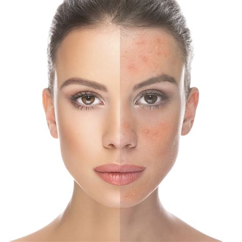 Acne Skin Treatments Ottawa Dermis Advanced Skin Care Ottawa