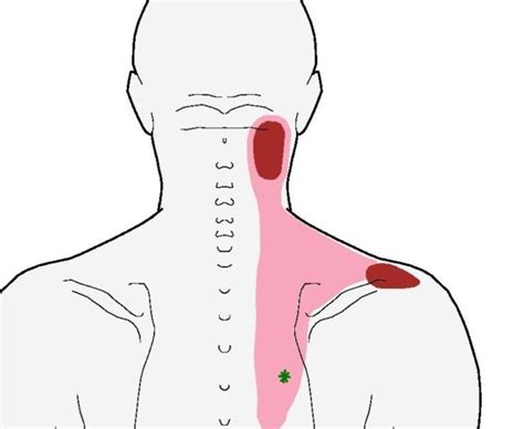 Pain Relief Understanding Trigger Points Pain In The Upper Neck With