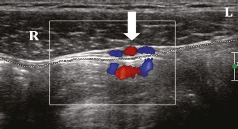 Scielo Brazil Ultrasound Evaluation Of Inguinoscrotal Pain An