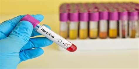 Rotavirus commonly causes severe, watery diarrhea the most common symptoms of rotavirus are severe watery diarrhea, vomiting, fever, and/or abdominal pain. Implementation of Rotavirus Surveillance and Vaccine Introduction — World Health Organization ...