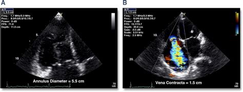Echocardiographic Assessment Of Right Ventricular Function How To
