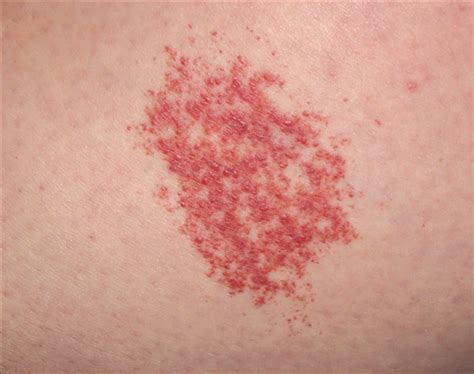 Acquired Agminated Acral Angioma A Novel Vascular Lesion Dermatology