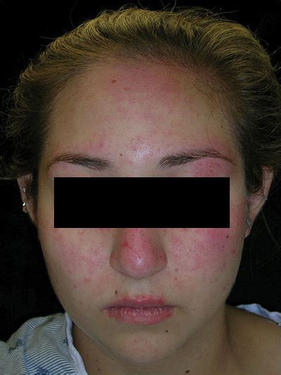 Sunscreen Allergy Face Buy Piz Buin Allergy Sun Sensitive Skin Face