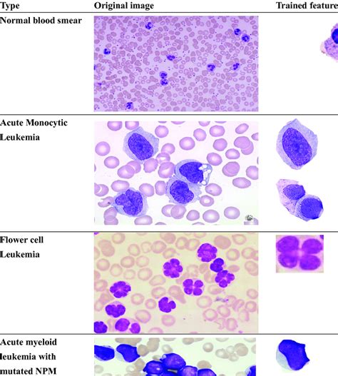 Leukemia Types