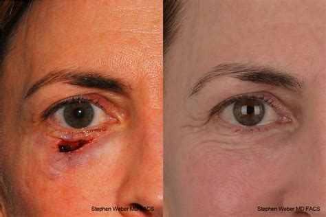 Scar Revision Before And After 11 Weber Facial Plastic Surgery