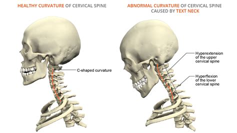 text-neck-anatomy-of-a-modern-spine-condition