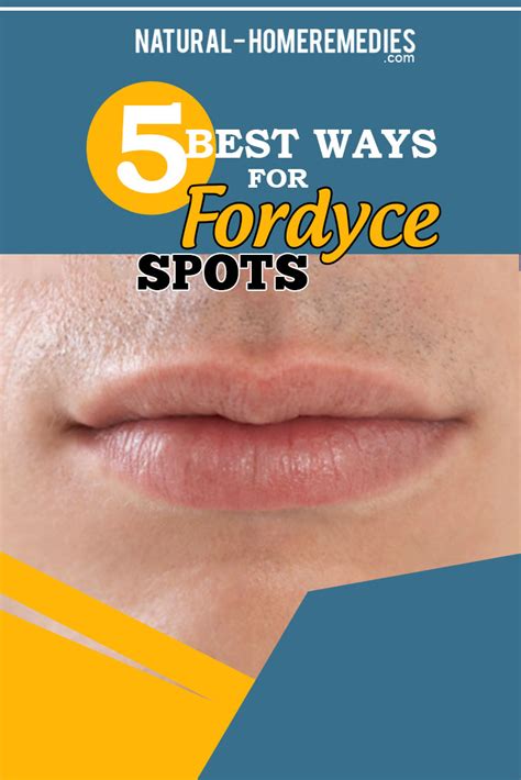 5 Best Ways For Fordyce Spots Natural Home Remedies And Supplements