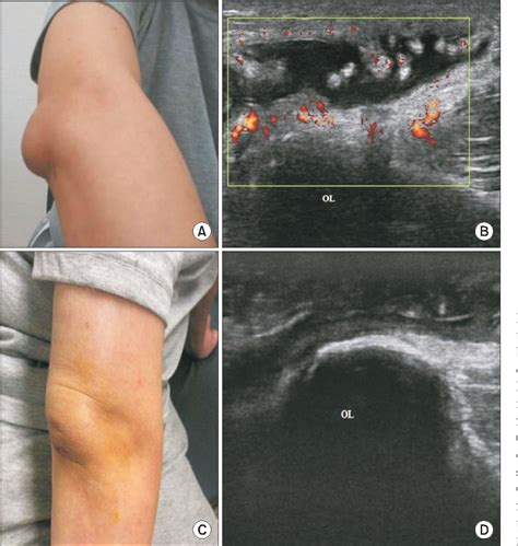 Figure 1 From Ultrasound Guided 50 Ethyl Alcohol Injection For