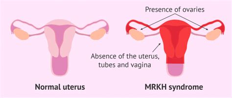 What Is Mrkh Syndrome Causes Symptoms And Treatment