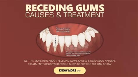 Receding Gums Causes And Treatment