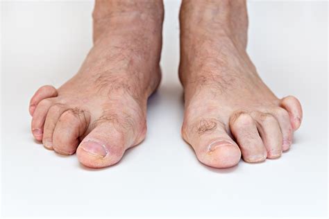How To Correct Multiple Hammer Toes On The Foot
