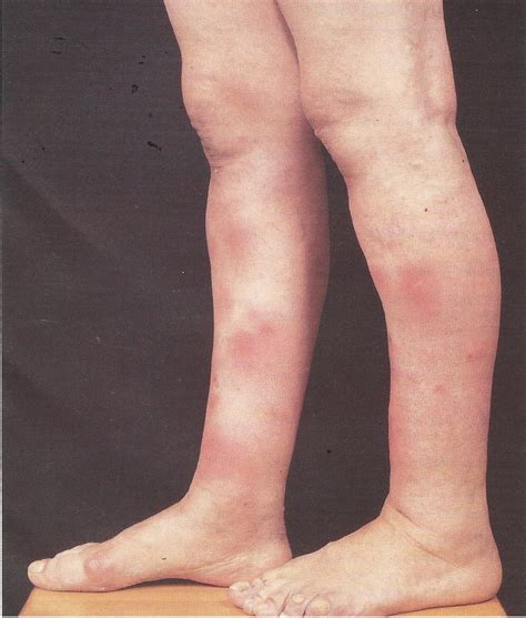 Fibromyalgie, die person ist beim erwachen müder als am abend zuvor, angst und depression, gewöhnlich ist der schlimmste moment am morgen, afrikanische trypanosomiasis, schwierigkeiten beim aufstehen am morgen, lupus, die morgendliche steifigkeit ist typisch. Erythema nodosum, Therapie, Diagnose, Sarkoidose, Ursachen ...