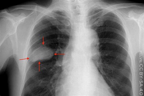 Clinical Challenges Small Cell Lung Cancer Medpage Today